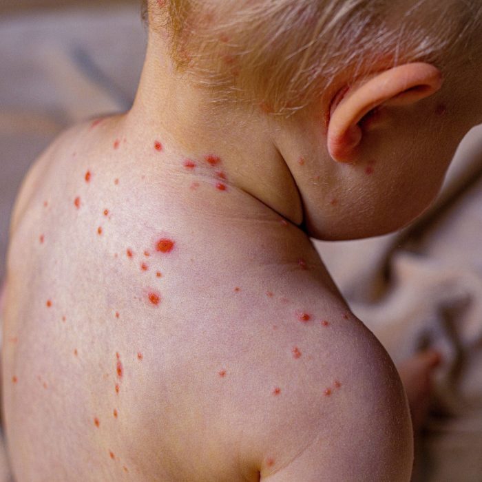 Baby with chicken pox