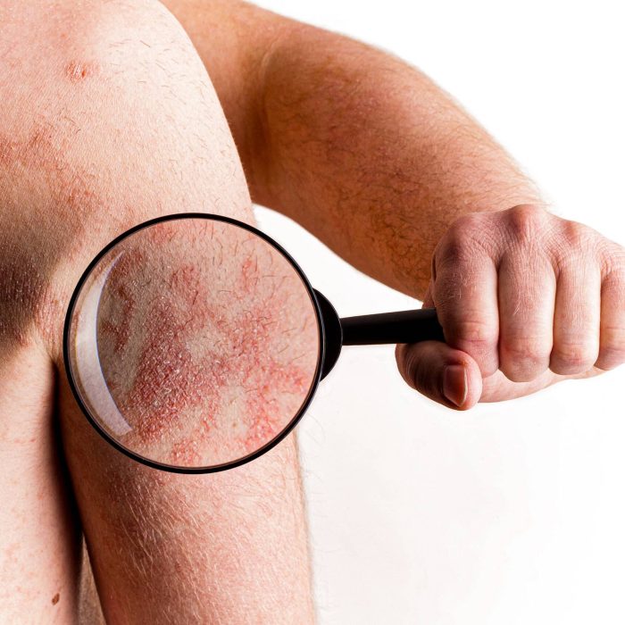 Medical Exam - Psoriasis