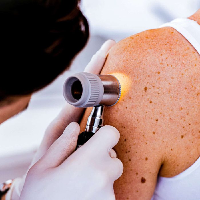 cropped view of dermatologist in latex gloves holding dermatoscope while examining patient with skin disease